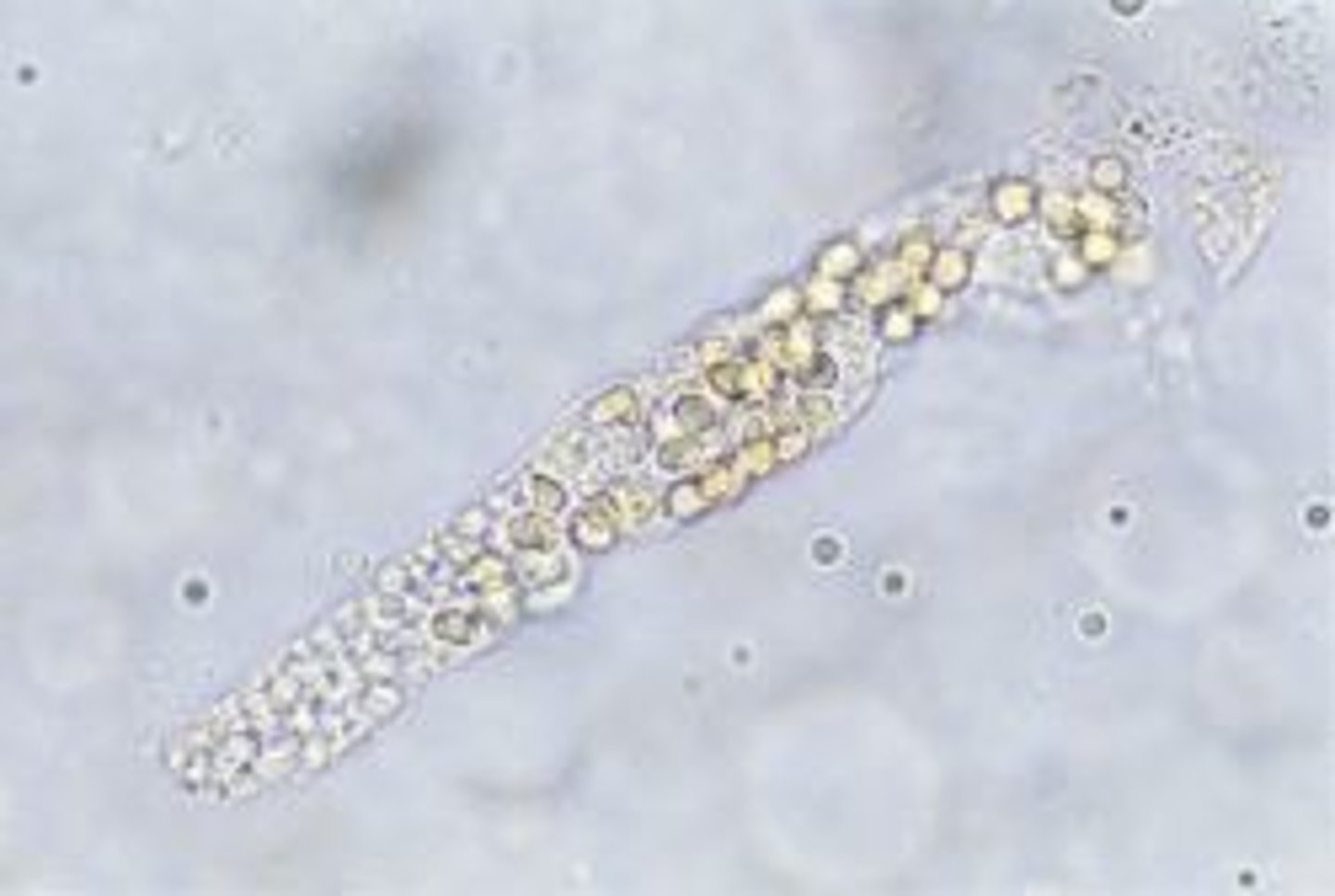 <p>fat droplets and oval fat bodies attached to protein matrix</p><p>-sources of error= fecal debris</p><p>-reported= avg. # per lpf</p><p>-correlations= protein, free fat droplets, oval fat bodies</p>