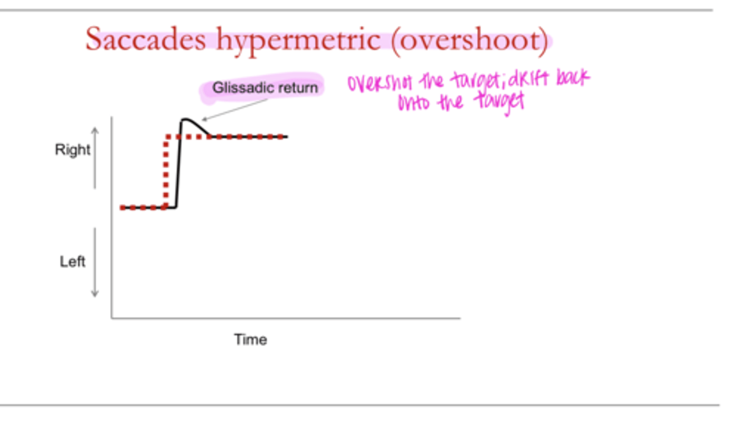 <p>Saccades HYPERMETRIC Overshoot (Pic)</p>