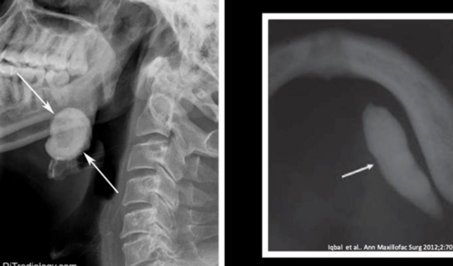 <p>false; sialoliths appear as radiopaque masses on radiographs</p>