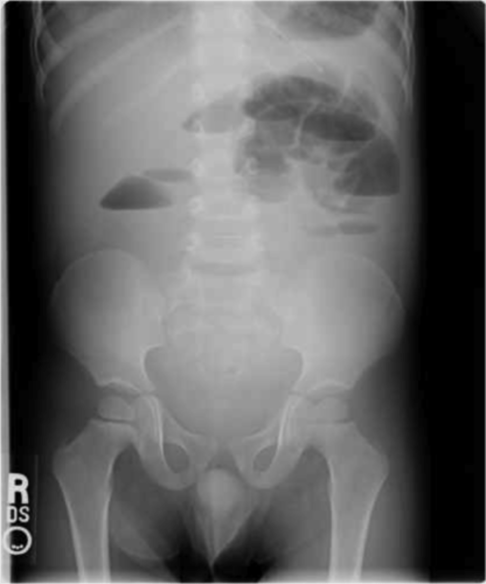 <p>X-Ray shows multiple dilated bowel loops, "step ladder appearance", no or little gas in colon/rectum</p><p>CT shows transition point, small-bowel feces sign (proximal to transition intestinal debris and fluid accumulate</p>