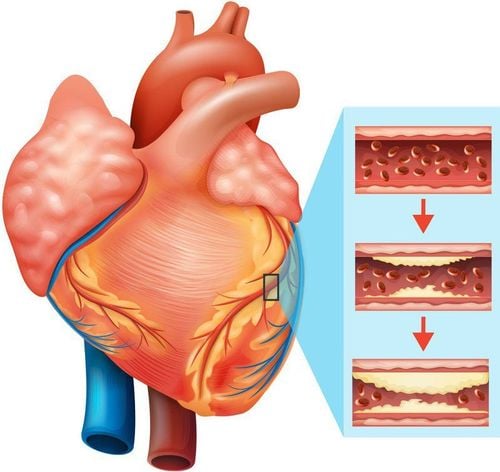 <p>Coronary artery disease (CAD)</p>