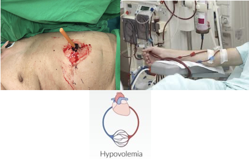 <ul><li><p>﻿External bleeding (trauma)</p></li><li><p>﻿﻿Internal bleeding (GI or bleeding disorders)</p></li><li><p>Burns</p></li><li><p>﻿﻿Diarrhea/vomiting</p></li><li><p>﻿﻿Dehydration</p></li><li><p>﻿﻿Diuresis (such as via hemodialysis)</p></li><li><p>﻿﻿Diabetes insipidus﻿</p></li></ul><p></p>