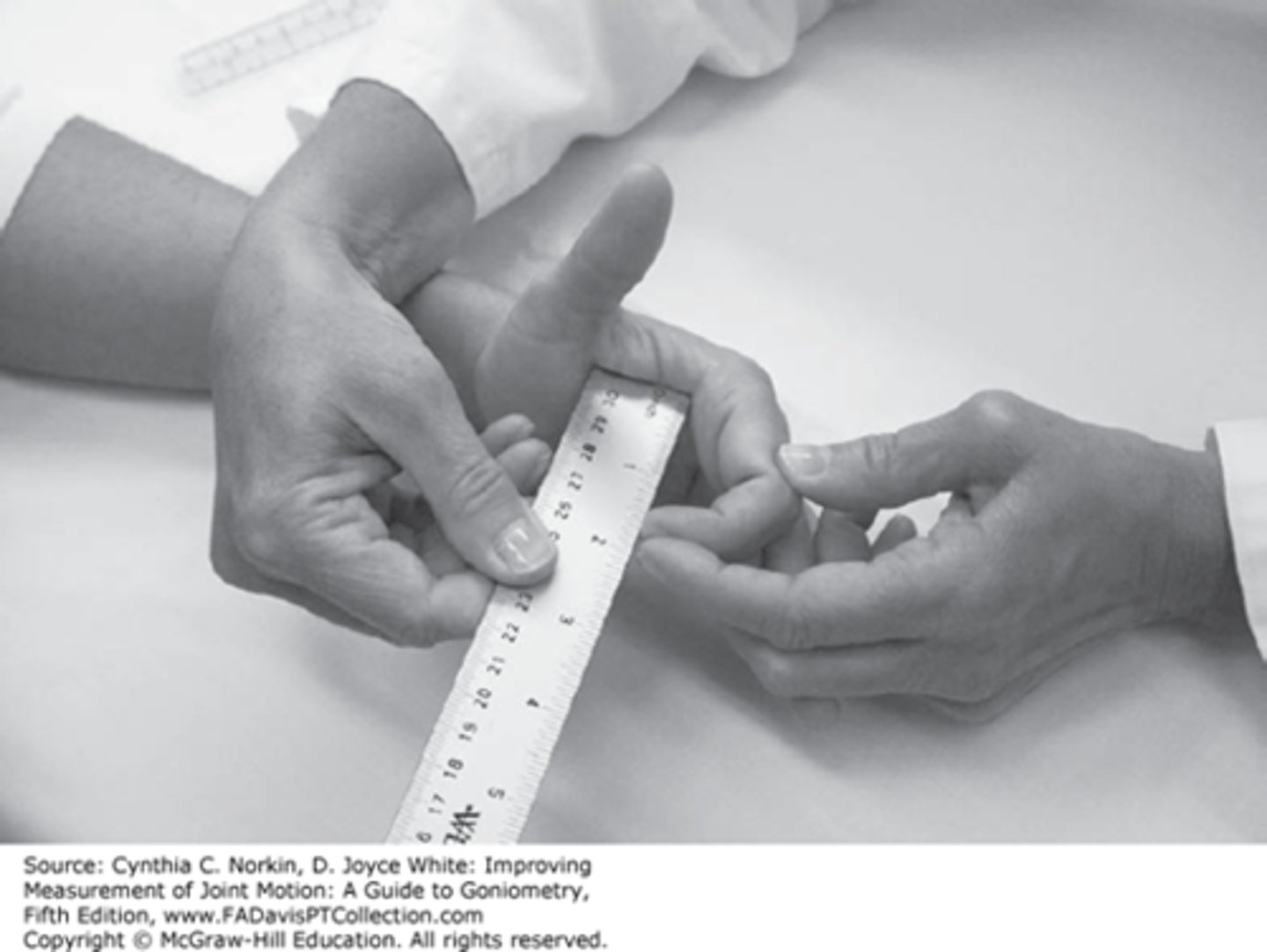 <p>Measure from distal palmar crease to tip of finger</p><p>Tip should be able to touch palmar crease for norma</p>