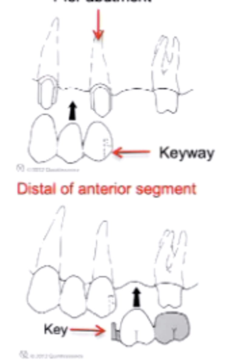 <p>Distal of the retainer</p>
