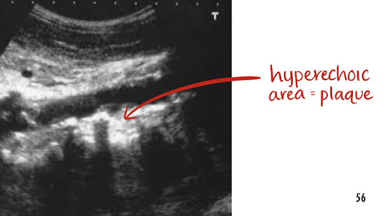 <ul><li><p>a form of arteriosclerosis</p></li><li><p>a buildup of <u>plaque</u> along arteries wall </p></li><li><p>must note in preliminary report if seen</p></li></ul><p></p>