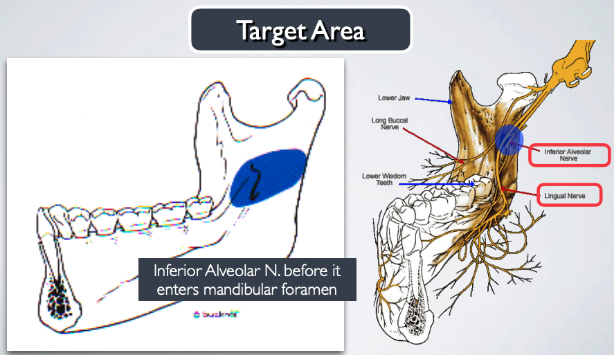 <p>target area for which nerve block?</p>