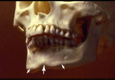 <p>Mental ridge</p><ul><li><p>linear prominence of cortical bone located on the external surface of the anterior portion of the mand.</p></li><li><p>Radiography: thick radiopaque band from premolar region to the incisal region </p><ul><li><p>often appears superimposed over the mandibular anterior teeth </p></li></ul></li></ul><p></p>