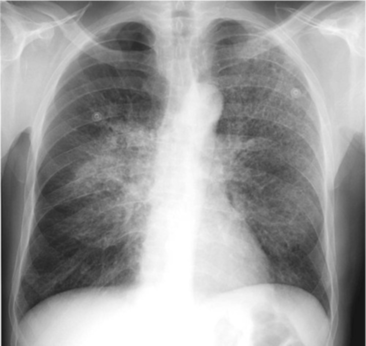 <p>-Bilateral, central disease that is primarily reticular in nature</p>