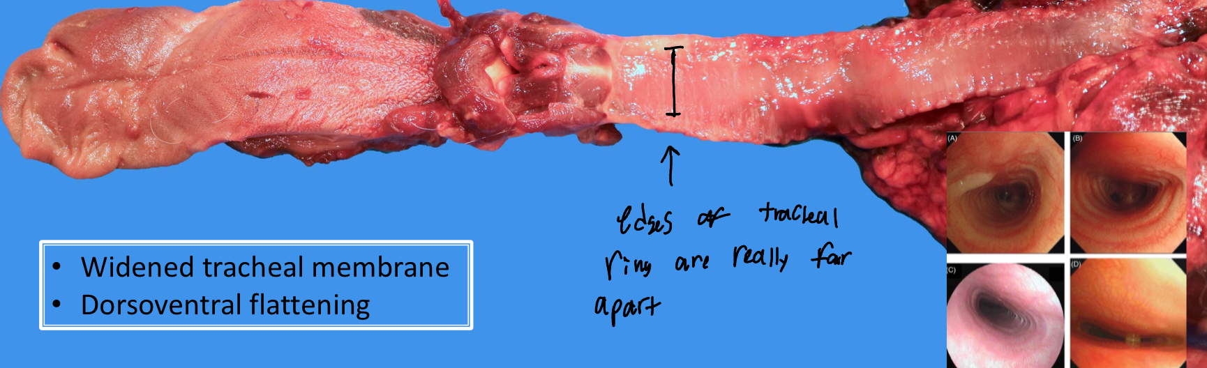 <ul><li><p>A congenital anomaly that is caused by the <u>degradation of cartilage in the trachea</u></p><ul><li><p>The degeneration results in the dorsoventral flattening of the trachea</p></li></ul></li></ul><p></p>