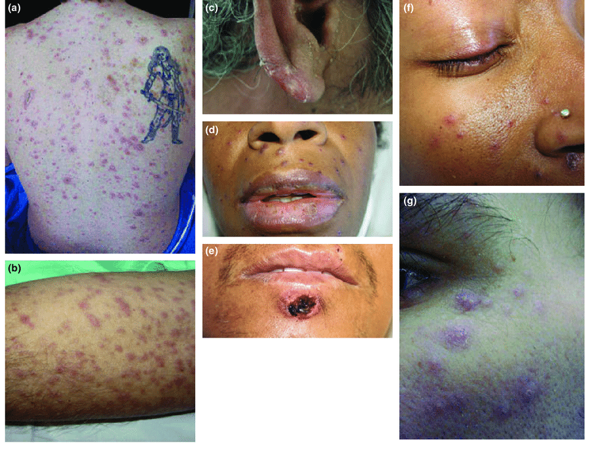 <p>erythematous, tender nodules</p>