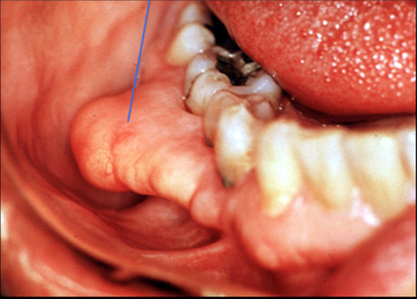 <p>slow grow</p><p>fine unless denture</p>