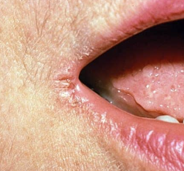 <p>Secondary Skin Lesion</p>