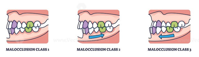 <p>EH Angle’s classification system (dental classification)</p><ul><li><p>Created by Dr Edward Angle in 1887</p></li><li><p>based primary on the relationship between permanent 1M to each other and the relationship of the permanent canines to each other. </p></li><li><p><strong>note: it is possible for classifications to be different on different sides of the mouth. </strong></p></li></ul><p></p>