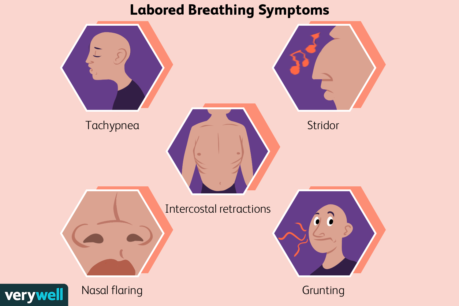 <p>signs of severe dyspnea of respiratory distress </p>