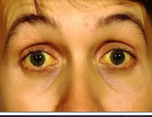 <p>excess billlirubin in bloodstream </p>