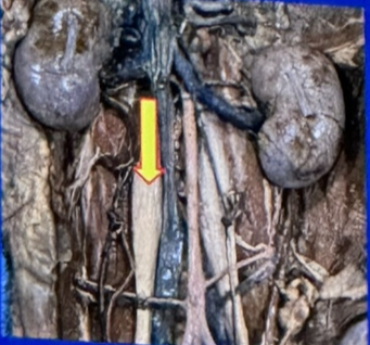 <p>which sublumbar muscle is indicated with the yellow arrow? </p>