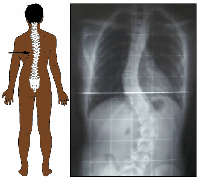 <p>abnormal lateral bending of the vertebral column</p>