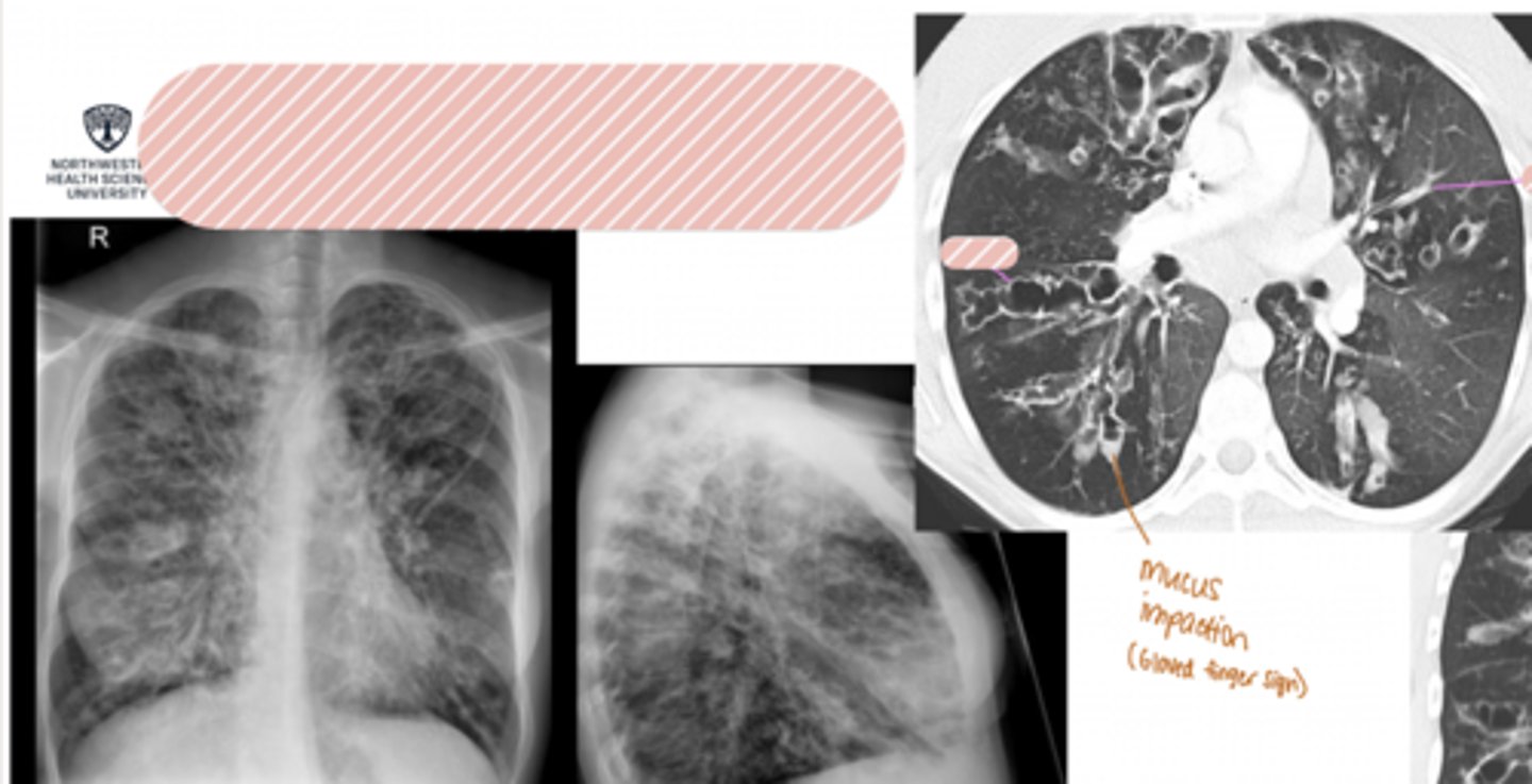 <p>Patient presents with chronic productive cough with thick, foul-smelling sputum, recurrent chest infections, hemoptysis, SOB, wheezing</p>