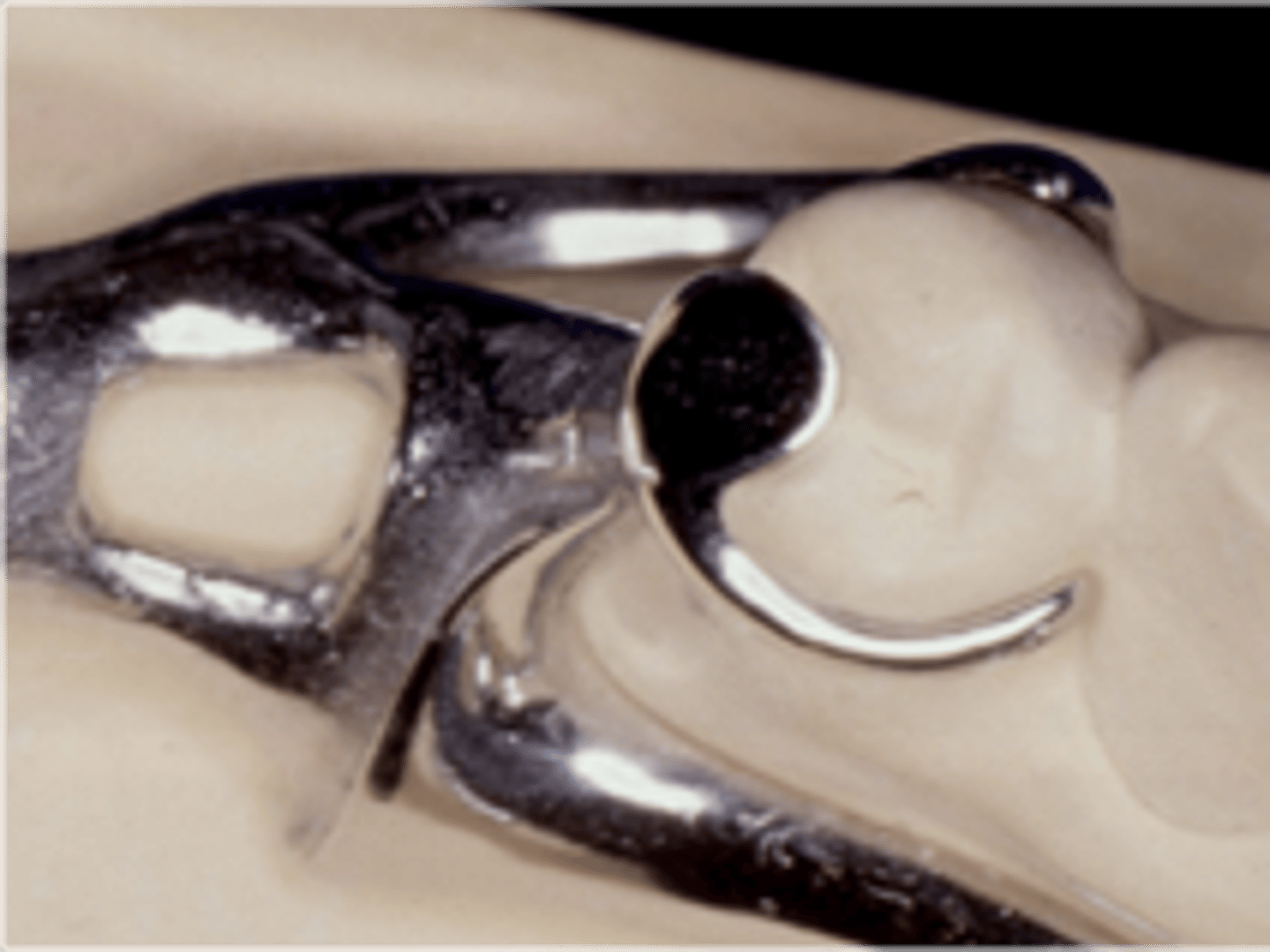 <p>Combination Clasps:</p><p>suprabulge/infrabulge combo, Commonly used on tooth borne RPDs in esthetic areas.</p>