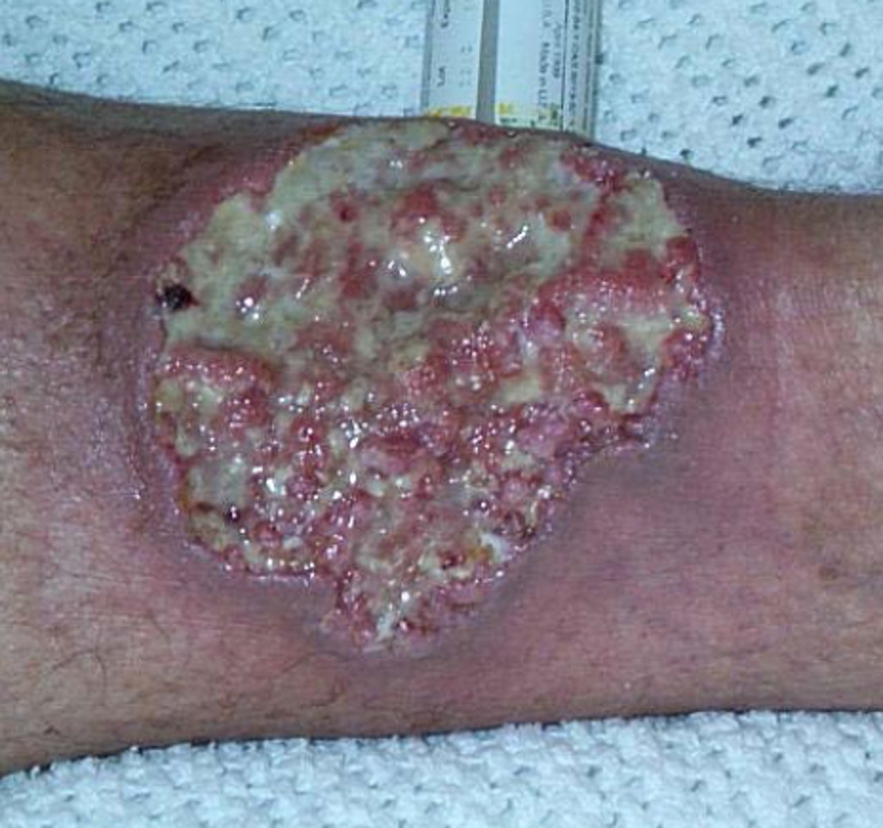 <p>diagnose this:</p><p>Inflammatory papule or pustule that progresses to a painful ulcer</p>