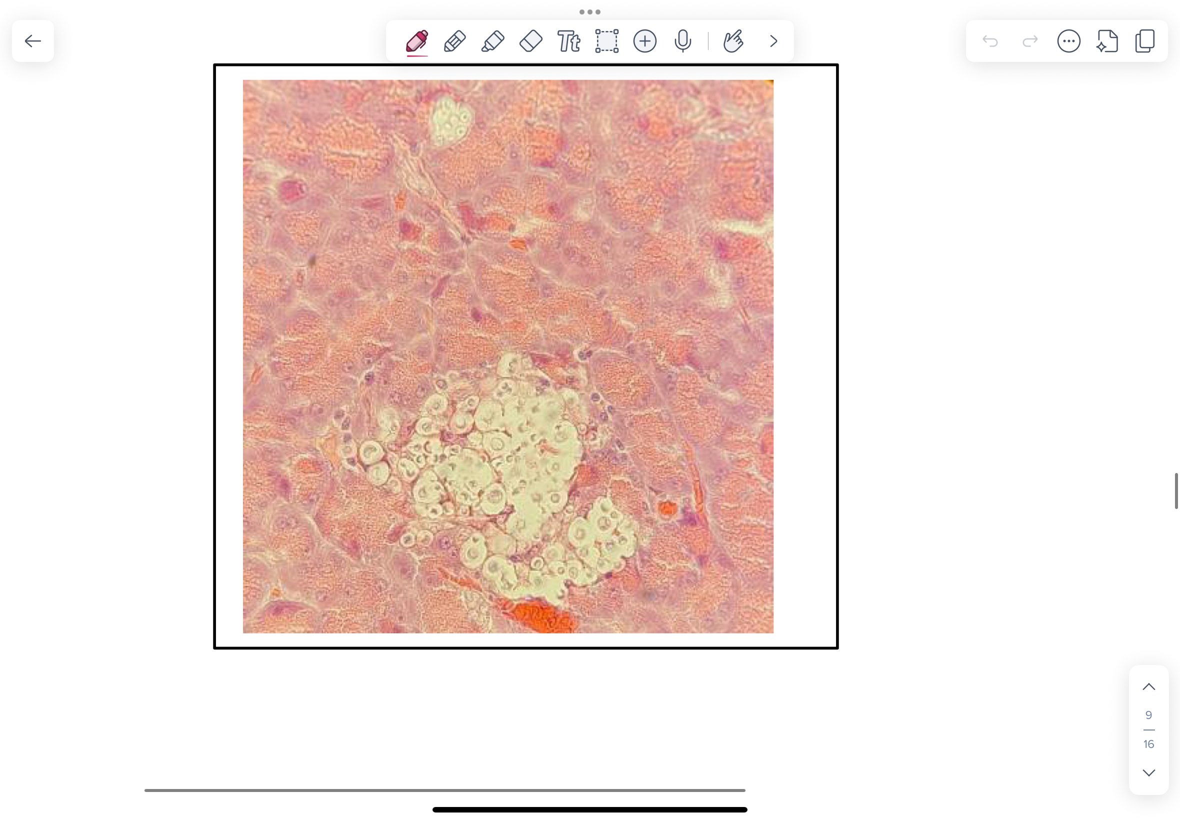 <p>NOTE Cryptococci are typically round (3-15 µm) with daughter cells budding on a narrow base.</p><p>To locate yeast in this histological section, look for clusters of “empty-spaces” or “soap-bubbles” within inflammatory cell infiltrates. These are a result of yeast bodies surrounded by a wide capsular space that does not take up stain. If you look closely you will see bluish-grey yeast bodies.</p>