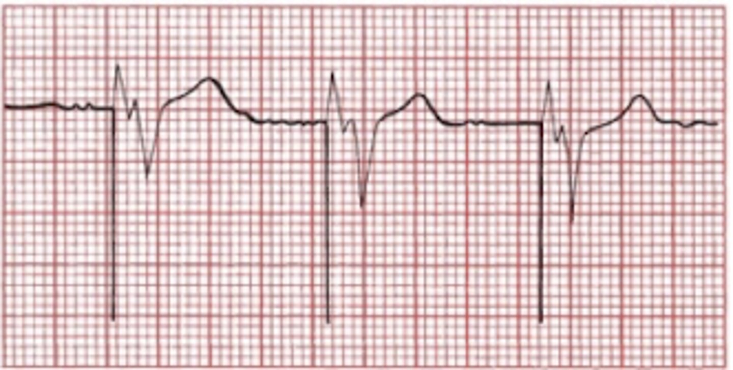 <p>-no P wave</p><p>-spike followed by wide/ bizarre QRS like LBBB</p>