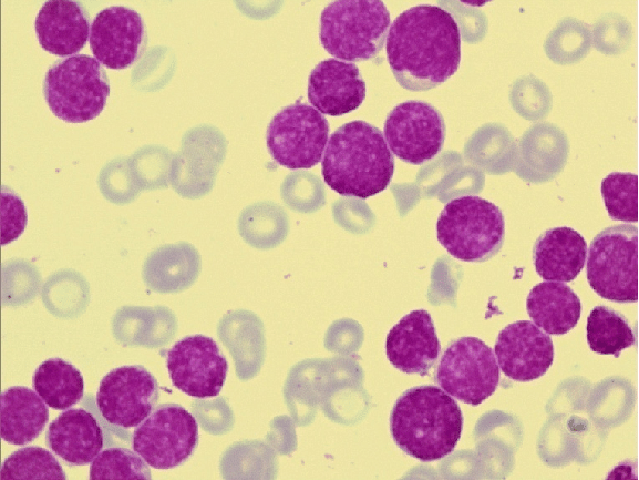 <ul><li><p>T-ALL prognosis is poorer in children, B-ALL prognosis is better</p><ul><li><p><u>opposite for adults:</u> T-ALL is better than B-ALL, overall survival rate is 60%-70%</p></li></ul></li><li><p>children with favorable prognoses can be treated with less toxic regimines</p></li><li><p><strong>treatment:</strong> chemotherapy, immunotherapies, molecular testing</p></li><li><p><em>picture shows B-ALL</em></p></li></ul><p></p>