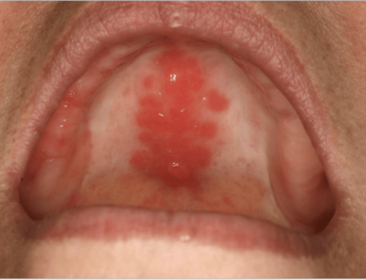 <p>When the patient removed their complete maxillary denture, you see this. They reported wearing their denture to continuously throughout the day & night. What do you suspect?</p>