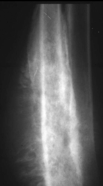 <p>What periosteal reaction?</p>