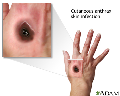 <p>coal, anthrax<br>eg. anthracoid</p>