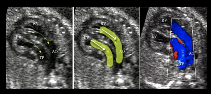 <p>if the LVOT + RVOT are parallel as they exit the fetal heart</p><p>a) complete transposition of the great vessels</p><p>b) truncus arteriosus</p><p>c) tetralogy of fallot </p><p>d) normal cardiac outflow anatomy </p>