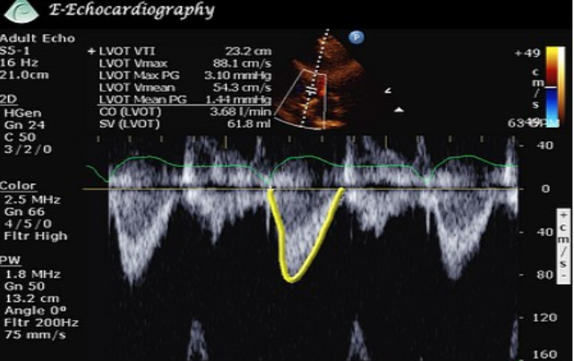 <ol><li><p>VTI</p></li><li><p>Peak velocity</p></li><li><p>Mean velocity</p></li><li><p>Peak pressure gradient</p></li><li><p>Mean pressure gradient</p></li></ol><p></p>