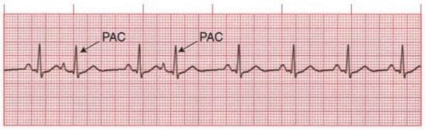 <p>usually common and benign</p><p>triggers: stress, caffeine, alcohol, and tobacco</p><p>can signal atrial irritability which may precede to a-fib, flutter, or SVT</p><p>s/s skipped beat</p><p>tx: usually none but continue to monitor and treat underlying cause</p><p>not usually an emergency unless frequent or symptomatic</p>