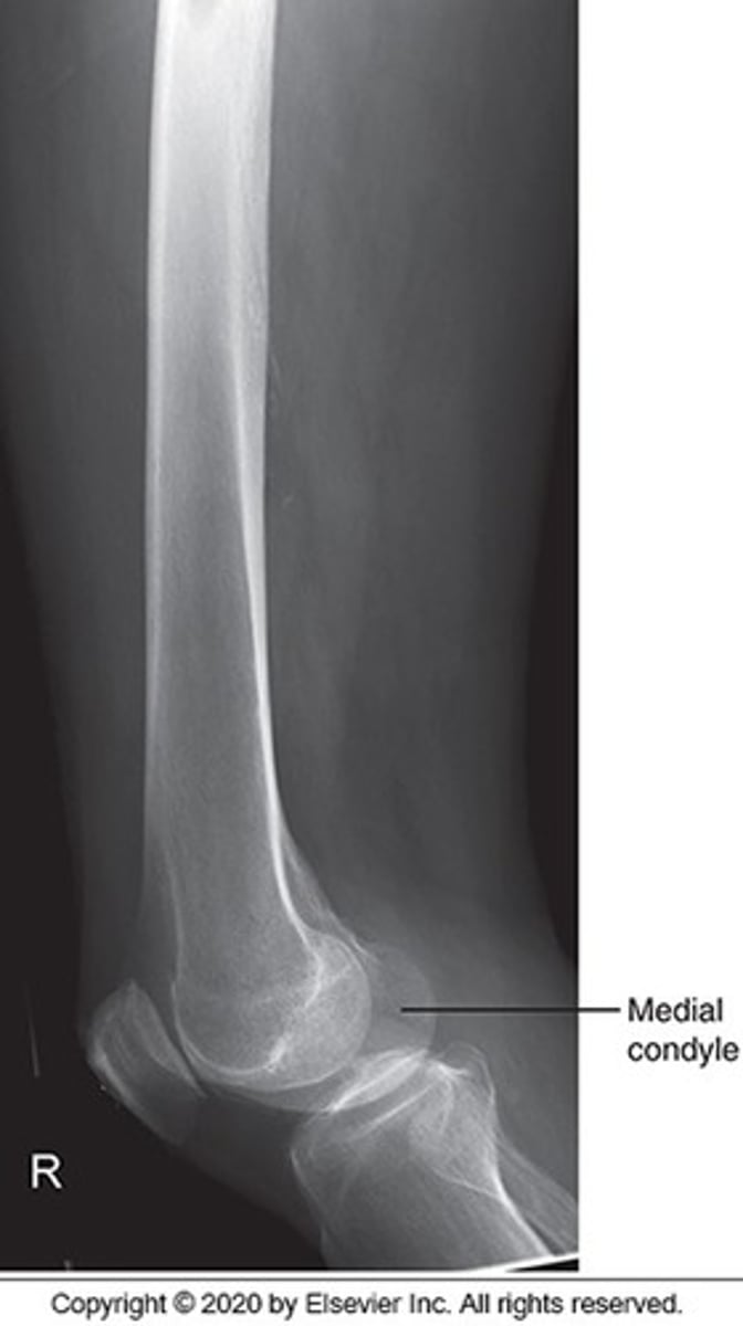 <p>CR perpendicular and 1/3 from the anterior surface of the femur.</p>