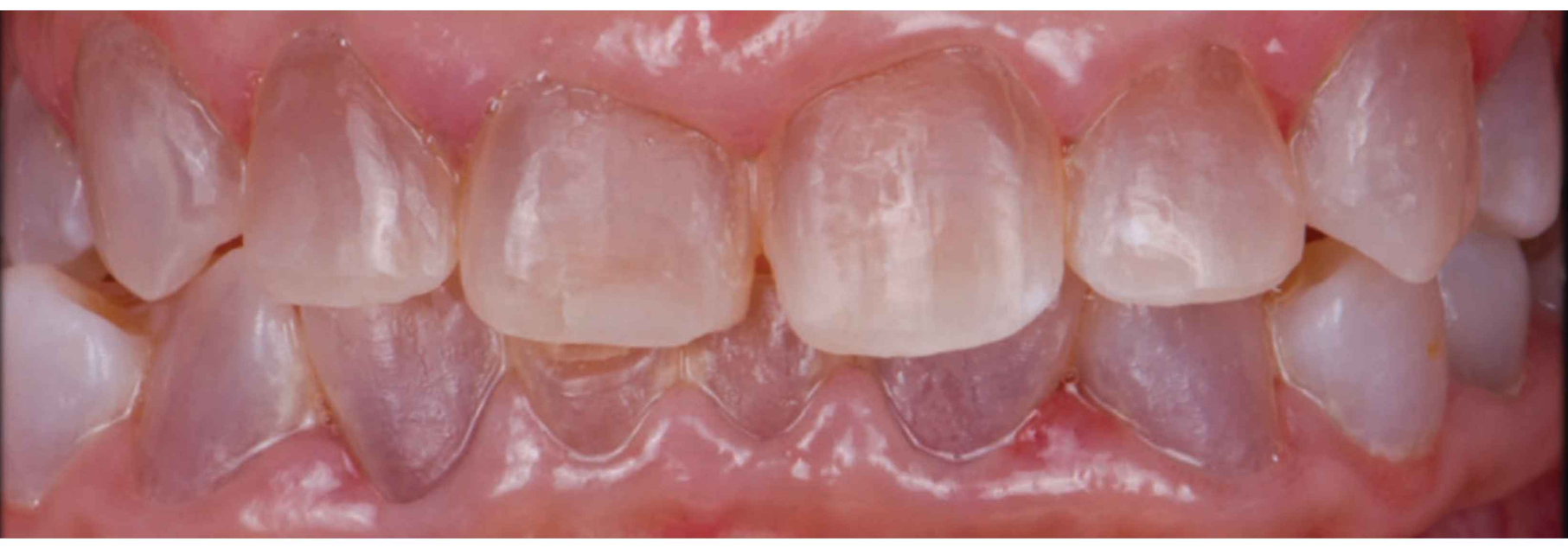 <ul><li><p><strong>Cause:</strong> Mutations in the <strong>DSPP gene</strong>, which alter the proteins produced, leading to <strong>abnormally soft dentin</strong></p></li><li><p><strong>Clinical features:</strong> Teeth are <strong>discolored, weak, and more prone to decay and fracture</strong></p></li></ul><p><strong>Types:</strong></p><ol><li><p><strong>Type I:</strong></p><ul><li><p>Occurs in people with <strong>osteogenesis imperfecta</strong> (brittle bones)</p></li><li><p>Mutations in <strong>COL1A1 or COL1A2</strong></p></li></ul></li><li><p><strong>Type II:</strong></p><ul><li><p>Occurs <strong>without another inherited disorder</strong></p></li><li><p>Some families have <strong>progressive hearing loss</strong> in older age</p></li><li><p>Most common type of dentinogenesis imperfecta</p></li></ul></li><li><p><strong>Type III:</strong></p><ul><li><p>Occurs <strong>without another inherited disorder</strong></p></li><li><p>First identified in families in <strong>southern Maryland</strong></p></li><li><p>Also reported in individuals of <strong>Ashkenazi Jewish descent</strong></p></li></ul></li></ol><p></p>