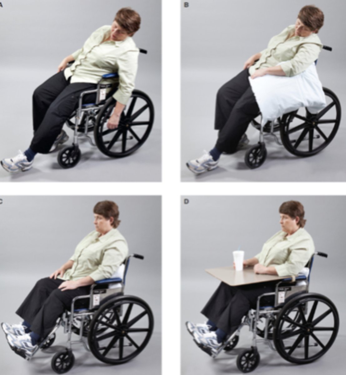 <p>A) This individual is completely unsupported and at risk for a variety of problems.</p><p>(B) Distal repositioning of the arm with a pillow does not correct the trunk position.</p><p>(C) More central support at the lateral trunk, and hip and knee repositioning using legrests, results in better overall positioning.</p><p>(D) The use of a lap board to provide additional shoulder girdle support further enhances the patient's functional position.</p>