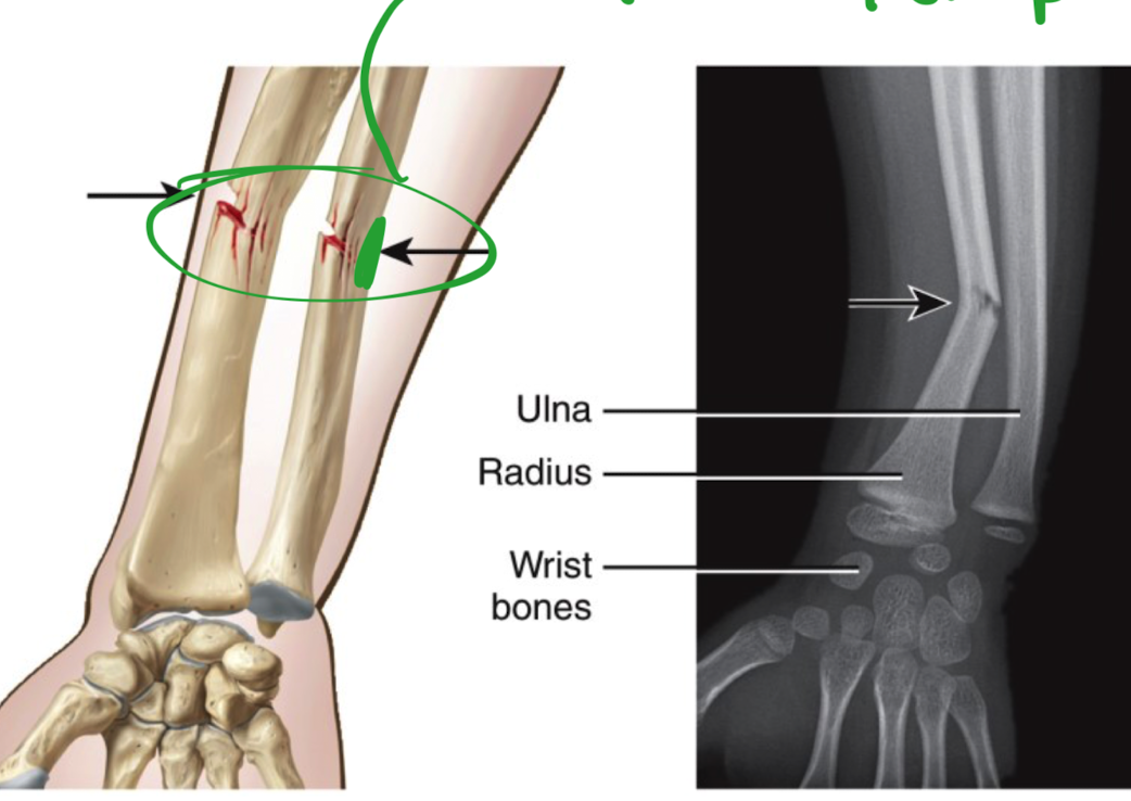<ul><li><p>in ulna </p></li><li><p>partial fracture - bends and snaps </p></li><li><p>occurs ONLY in children </p></li><li><p>bones are fully ossified </p></li></ul>