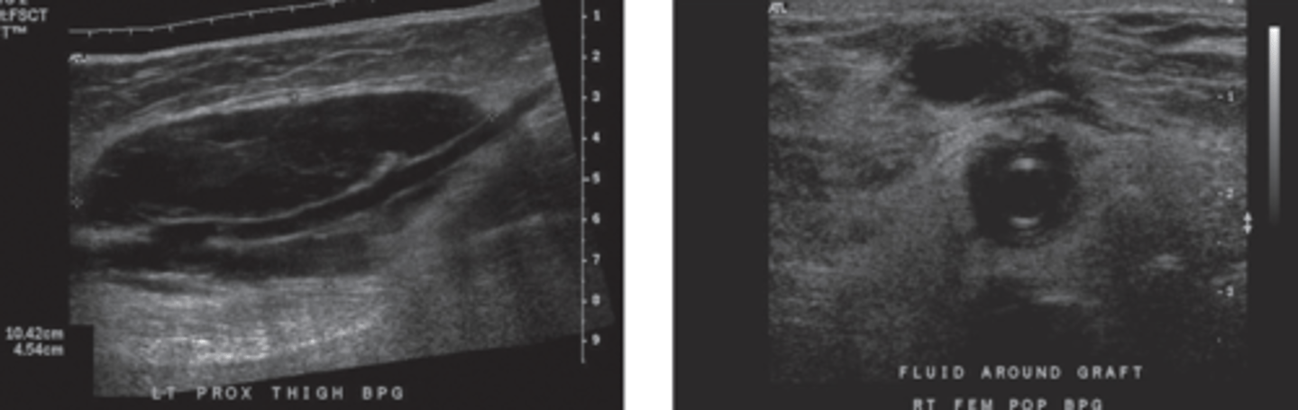 <p>Fluid collections around graft</p><p>May be hematoma</p><p>Can compress graft &amp; impact function</p><p>Can be infection</p>