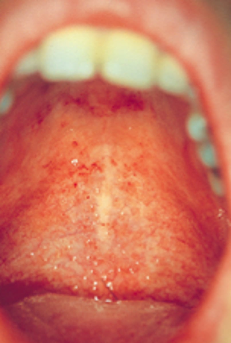 <p>Petechiae (small red spots that do not blanch with pressure) on the soft palate in 20% of patients with rubella.</p>
