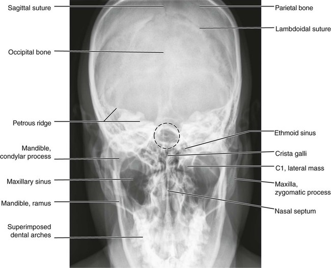 <p>30° caudal entering 2-2.5” above glabella</p><p></p><p>35° caudal going thru TMJ’s</p><p></p>