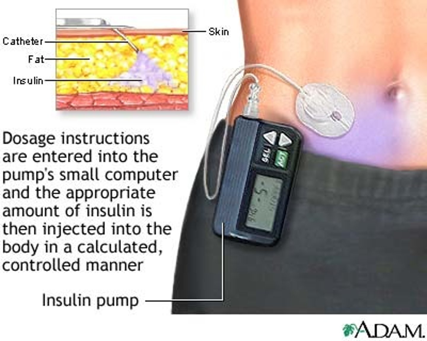 <p>IF patient on insulin pump, the basal dose is continuously delivered in a fast acting insulin form => therefore continuous infusion</p>