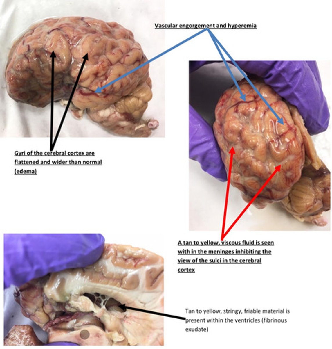 <p>The meninges are diffuse bright red with prominent blood vessels. Why do think the</p><p>meningeal vessels are engorged with blood?</p>