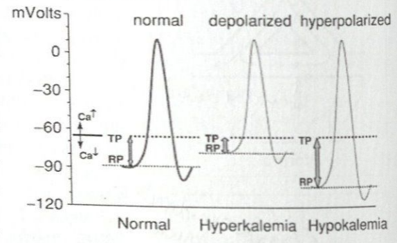 <p>As extracellular potassium levels increase, the resting membrane potential becomes less negative</p><p>Mild to moderate hyperkalemia may increase excitability and conduction velocity by its effect of increased membrane permeability accelerating the rate of repolarization and shortening the action potential duration</p><p>With progressive hyperkalemia, the resting membrane potential further depolarizes (becomes less negative) decreasing Na channel availability</p><ul><li><p>First happens in the atria, leading to a state of constant depolarization and loss of excitability</p></li><li><p>Loss of P wave, widening of QRS, and slower than expected HR on ECG are likely first indications of a life-threatening hyperkalemia</p><ul><li><p>Atrial standstill or sinoventricular rhythm</p></li></ul></li><li><p>Severe hyperkalemia causes a slowing of conduction velocity eventually to the point of propagation failure and inexcitability of both atria and ventricles → asystole or ventricular fibrillation</p></li></ul><p></p>