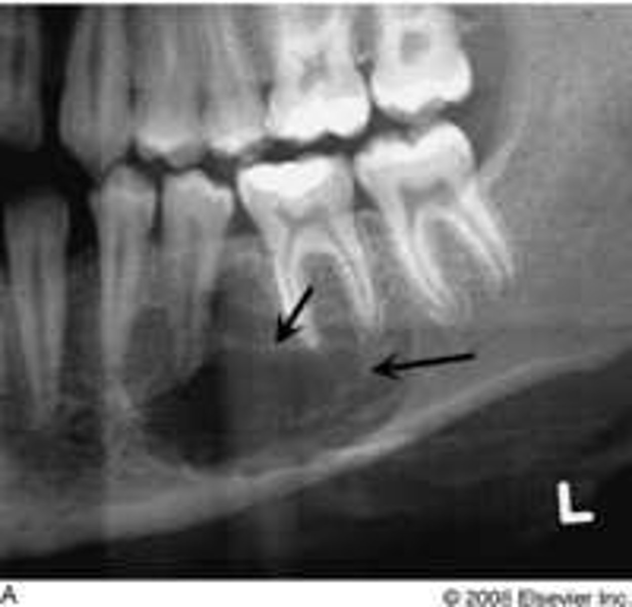 <p>Within bone; Can be seen radiographically</p><p><br>-may occur on the gingiva or alveolar ridge or in the maxilla or mandible</p><p>-divergence of the root of adjacent teeth is a common feature</p>