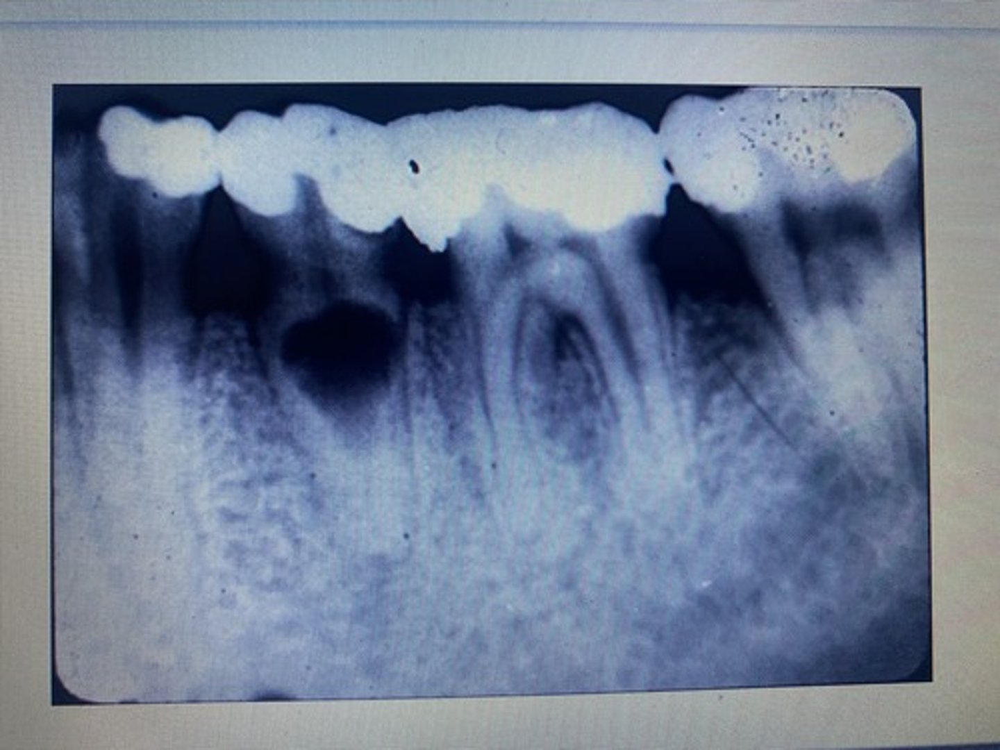 <p>Abnormal; Internal Root Resorption</p>