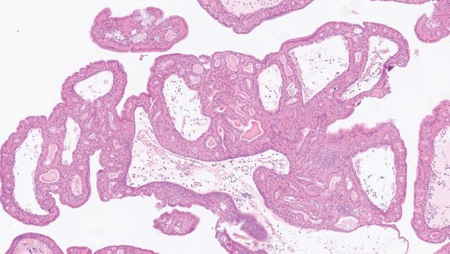 <p>patient de 50 ans, tumeur kystique de la parotide </p><p>1) Diagnostic </p><p>2) Localisation</p><p>3) Histologie </p>