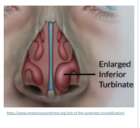 <p>tissue that swells as it absorbs more blood</p><ul><li><p>In the nose, this tissue is located in the epithelium of the inferior concha</p></li><li><p>Every 30 to 60 minutes, tissue on one side swells with blood</p></li><li><p>This restricts airflow through that fossa, so most air is directed through the other nostril</p></li><li><p>This allows the engorged side time to recover from drying</p></li></ul><p></p>