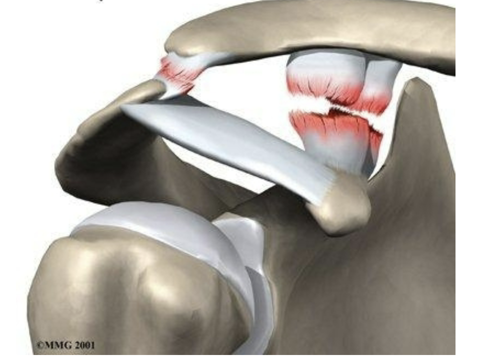 <ul><li><p>clavicle is higher on one side </p></li><li><p>limited mobility</p></li><li><p>extreme pain in shoulder</p></li><li><p>loss of function</p></li></ul><p></p>