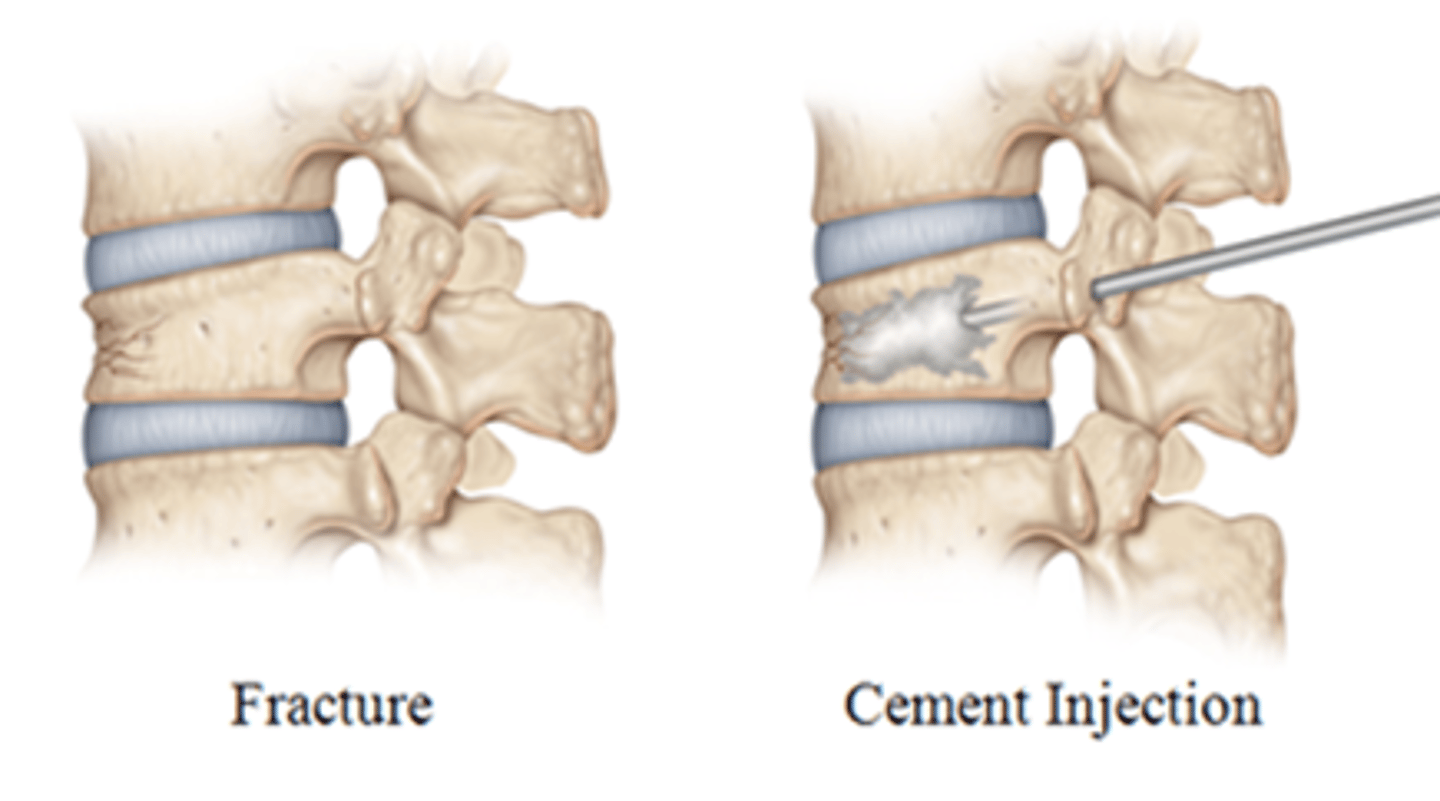 <p>Treatment of osteoporosis-related compression fractures by injecting bone cement to stabilize compression fractures within the spinal column.</p>