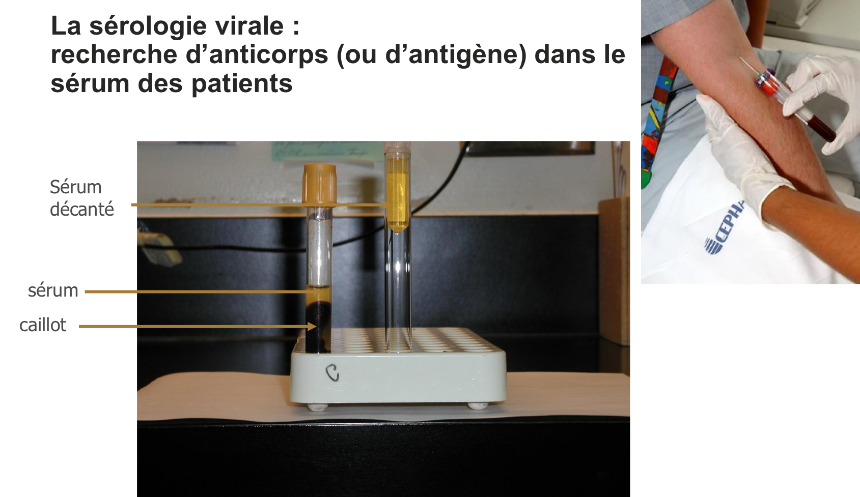 <p>Recherche d’anticorps (ou d’antigène) dans le sérum des patients </p>